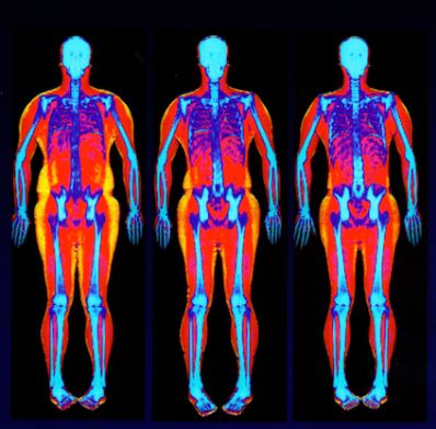 DEXA scan for identifying muscle imbalances