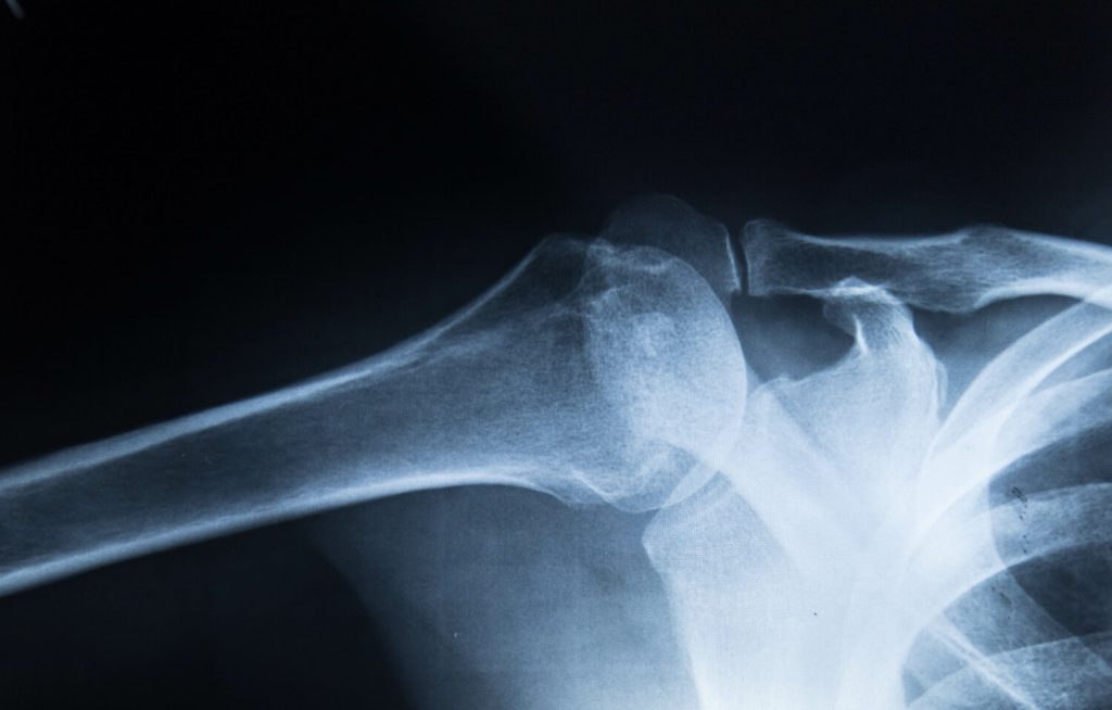 bone densitometry available at Dexa scan in Okanagan